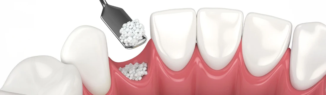 Dentist Lewiston ME Bone Graft detailed computer graphic rendering of a bone graft