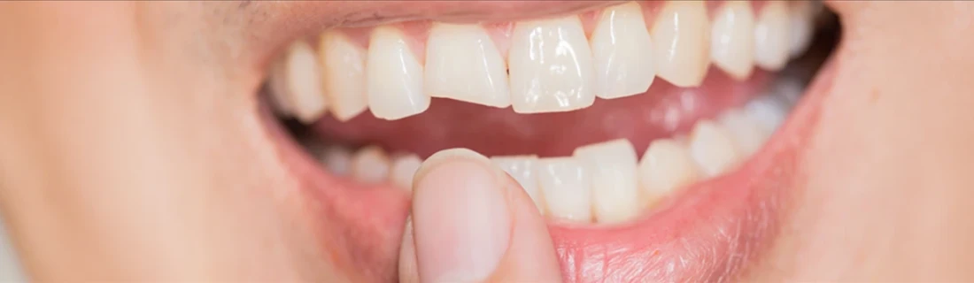 Dentist Lewiston ME Chipped Tooth close up photo of someone's mouth and they are pointing at their chipped tooth