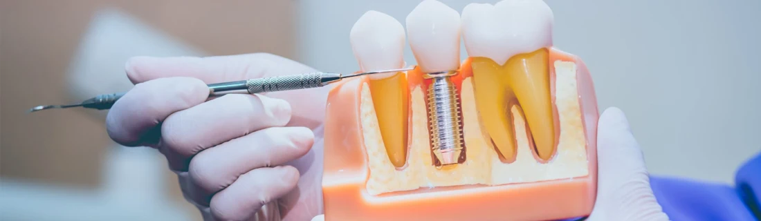Dentist Lewiston ME Dental Implant Failures photo of a dentist pointing at a model of a mouth that includes an implanted tooth