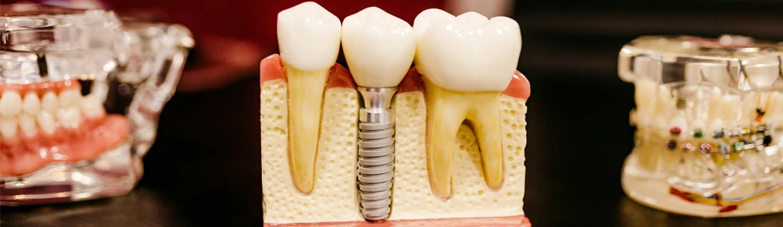 Dentist Lewiston ME Dental Implants Focused A close-up photo depicting a model of 3 teeth, with the middle one being a tooth implant
