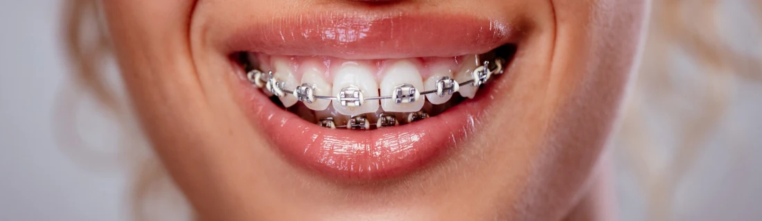 Dentist Lewiston ME Gaps in Teeth a close up on a mouth that has braces on the teeth