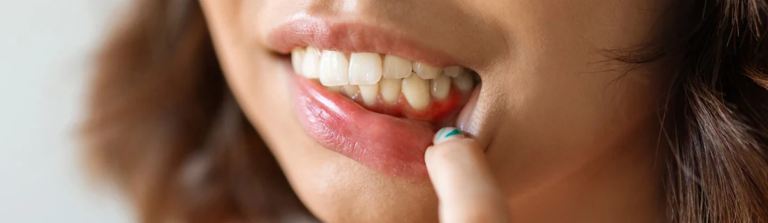 Dentist Lewiston ME Gum Disease Treatment close up of a woman pulling down her lip to expose inflamed gums