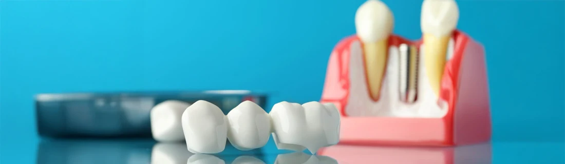 Dentist Lewiston ME Missing Teeth a photo of a dental bridge next to a model of teeth with a missing tooth